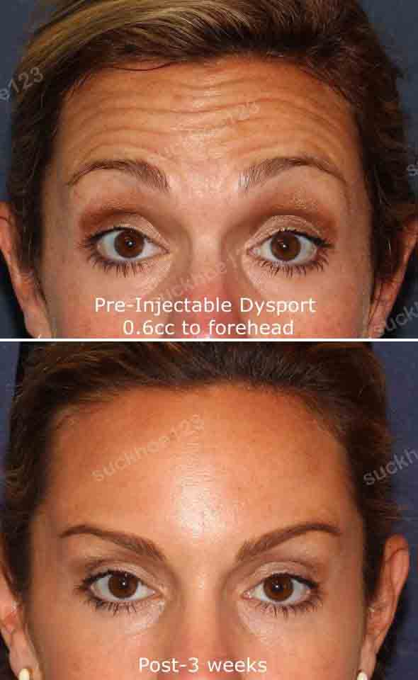 hinh anh tiem botox dr tam ca 17 nep nhan tran