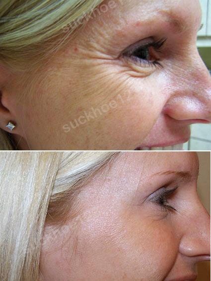 hinh anh tiem botox dr tam ca 2 1 vet chan chim