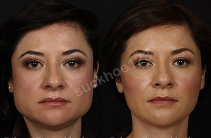 tiem botox thon gon ham chu de