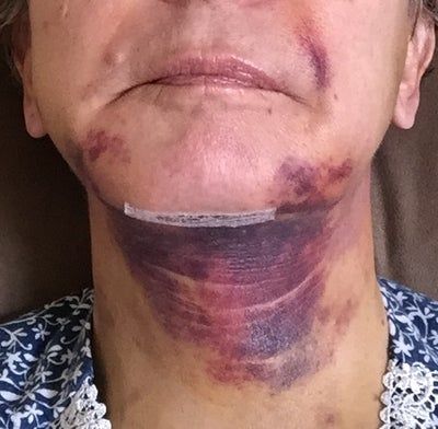 Căng da mặt để khắc phục má chảy xệ