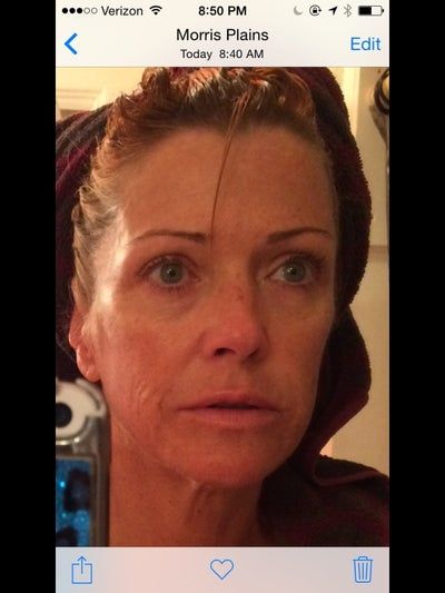 Quyết định căng da mặt sau một năm đắn đo