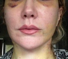 Căng da mặt sau khi phẫu thuật thẩm mỹ hỏng