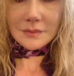 Căng da mặt sau khi phẫu thuật thẩm mỹ hỏng