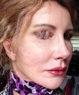 Căng da mặt sau khi phẫu thuật thẩm mỹ hỏng