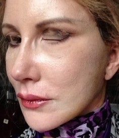 Căng da mặt sau khi phẫu thuật thẩm mỹ hỏng