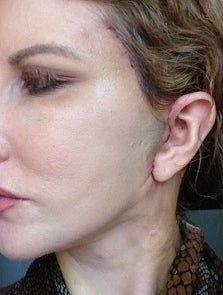 Căng da mặt sau khi phẫu thuật thẩm mỹ hỏng