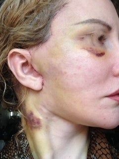 Căng da mặt sau khi phẫu thuật thẩm mỹ hỏng