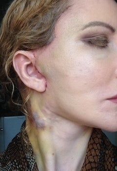 Căng da mặt sau khi phẫu thuật thẩm mỹ hỏng