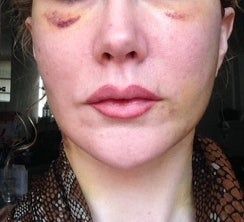 Căng da mặt sau khi phẫu thuật thẩm mỹ hỏng