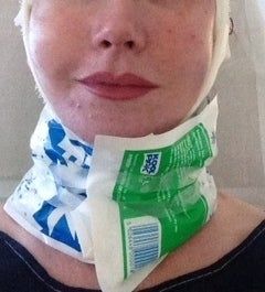 Căng da mặt sau khi phẫu thuật thẩm mỹ hỏng