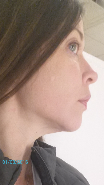 44 tuổi đã căng da mặt có sớm quá không?