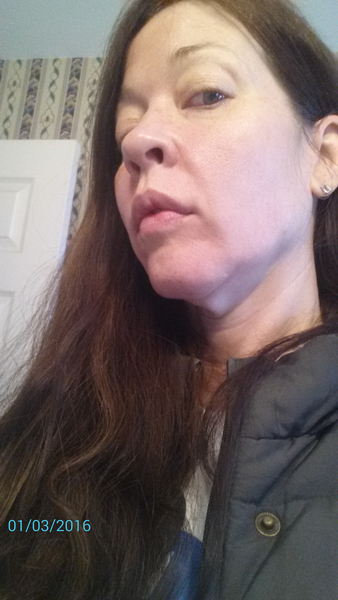 44 tuổi đã căng da mặt có sớm quá không?