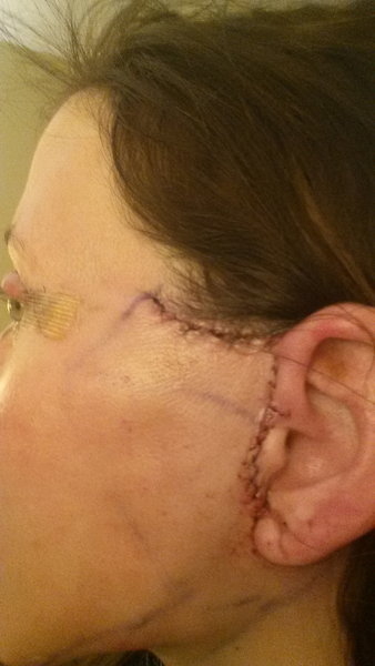 44 tuổi đã căng da mặt có sớm quá không?