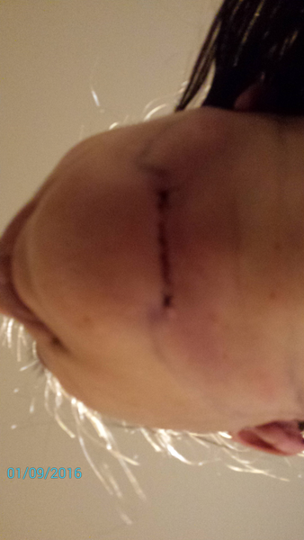 44 tuổi đã căng da mặt có sớm quá không?