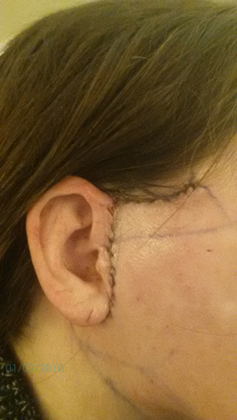 44 tuổi đã căng da mặt có sớm quá không?