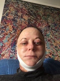 Căng da mặt với mức giá hợp lý