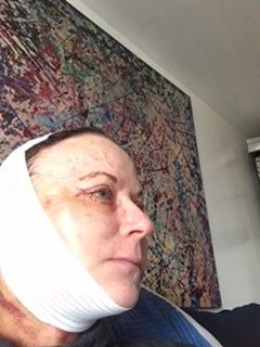 Căng da mặt với mức giá hợp lý