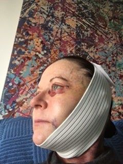 Căng da mặt với mức giá hợp lý