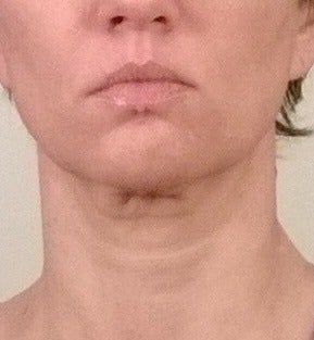 46 tuổi và đã sẵn sàng căng da mặt