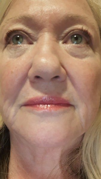 Căng da mặt ở tuổi 64