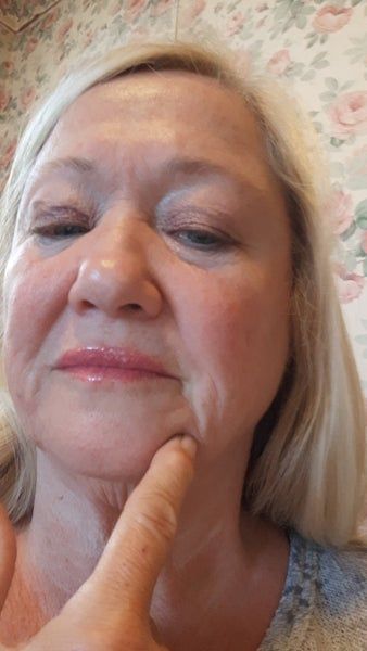 Căng da mặt ở tuổi 64