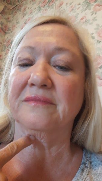 Căng da mặt ở tuổi 64