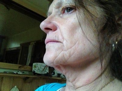 Vĩnh biệt khuôn mặt già nua nhờ căng da mặt bằng chỉ