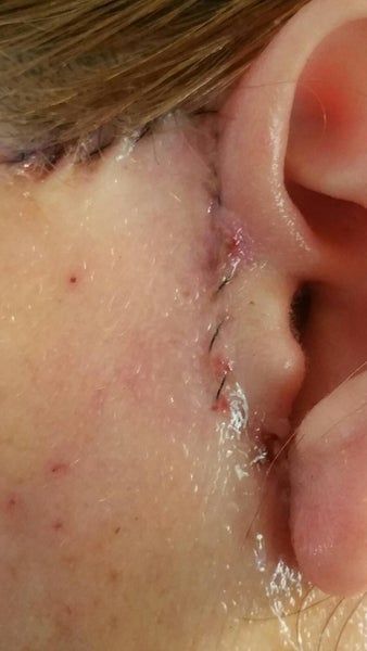 Kết quả hài lòng sau khi căng da cổ và căng da vùng mặt dưới ở tuổi 48