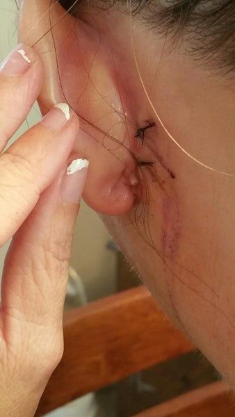 Kết quả hài lòng sau khi căng da cổ và căng da vùng mặt dưới ở tuổi 48