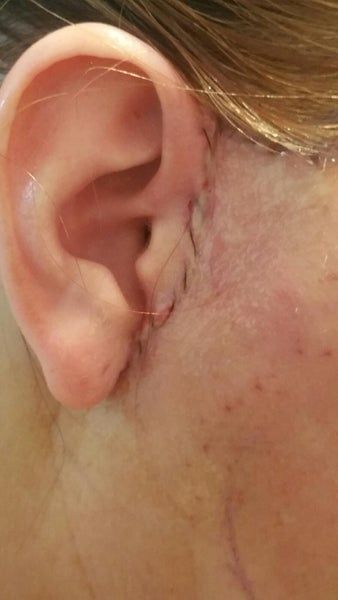 Kết quả hài lòng sau khi căng da cổ và căng da vùng mặt dưới ở tuổi 48