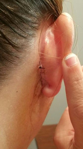 Kết quả hài lòng sau khi căng da cổ và căng da vùng mặt dưới ở tuổi 48