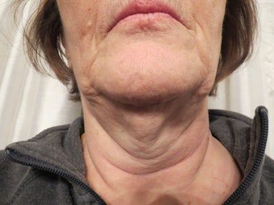 Trẻ hóa ở tuổi 65 với phương pháp căng da cổ/căng da quanh hàm