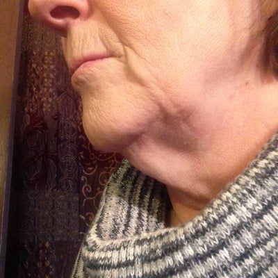 Trẻ hóa ở tuổi 65 với phương pháp căng da cổ/căng da quanh hàm