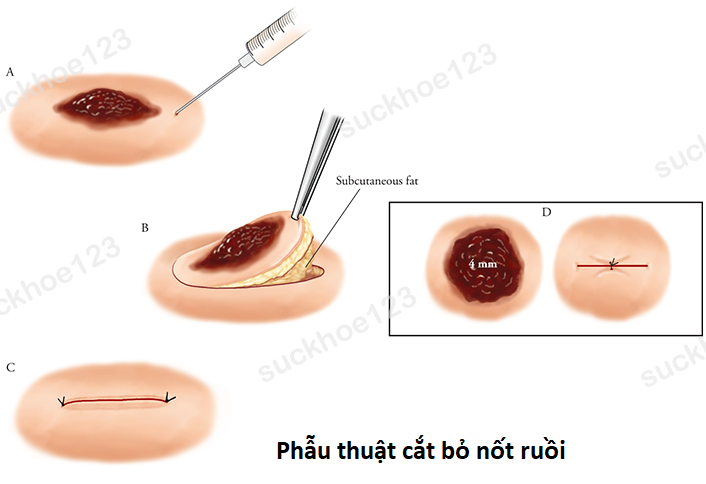 cat bo not ruoi