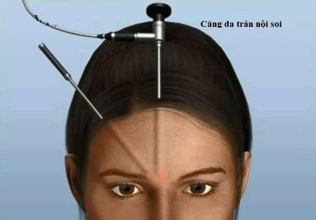căng da trán 2