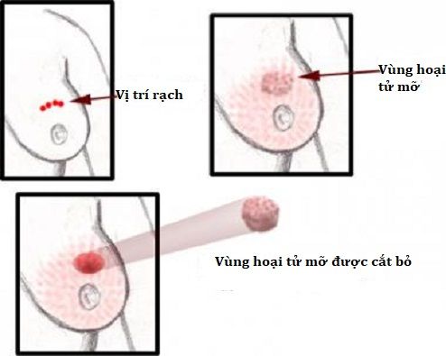 cắt bỏ