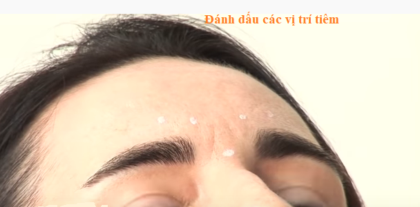 đánh dấu các điểm tiêm