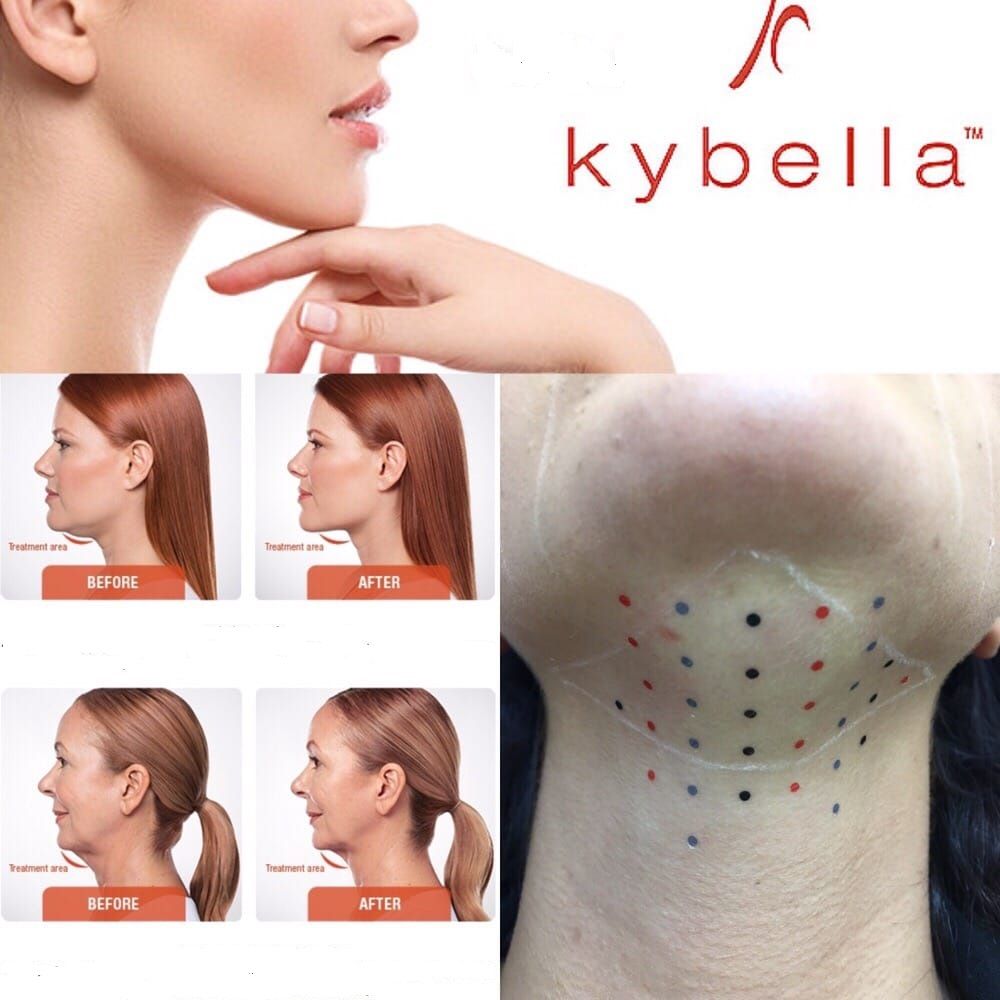 kybella