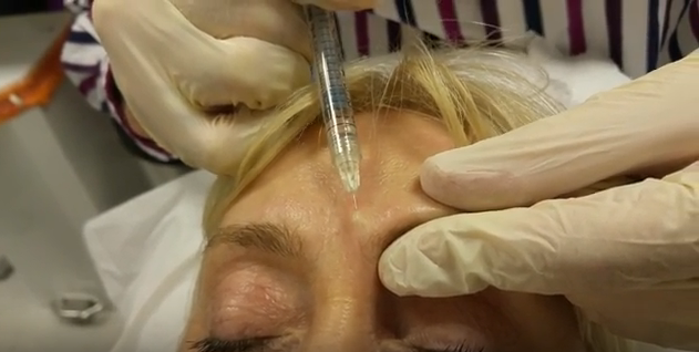 tiêm filler 2