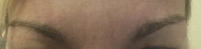 50 unit botox nep cau may