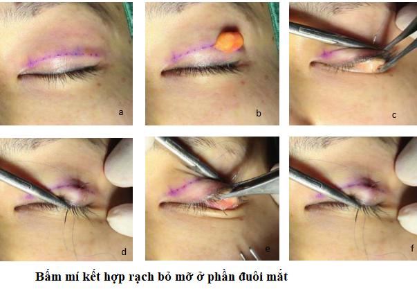 bấm mí 1