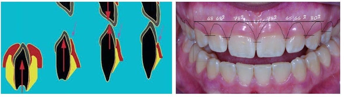 chậm mọc răng thụ động