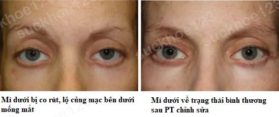co rút mí dưới 1