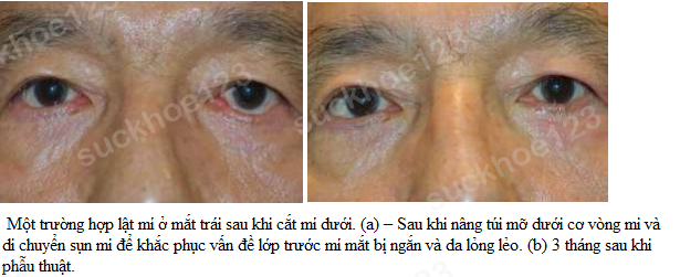 lật mí dưới 2