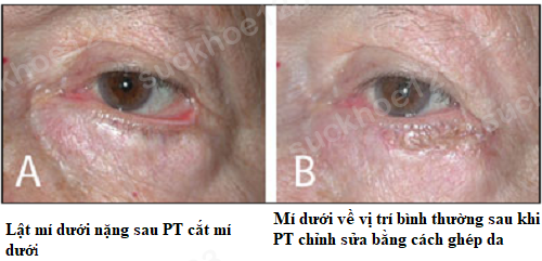 lật mí dưới 3 ghép da