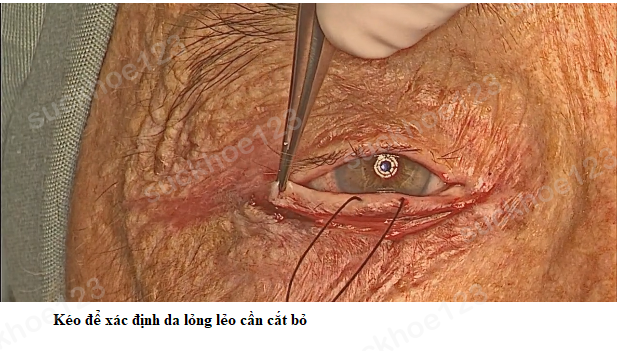 lật mí dưới 5 PT căng da mí dưới 2