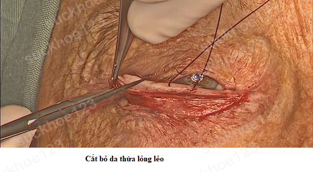 lật mí dưới 5 PT căng da mí dưới 3