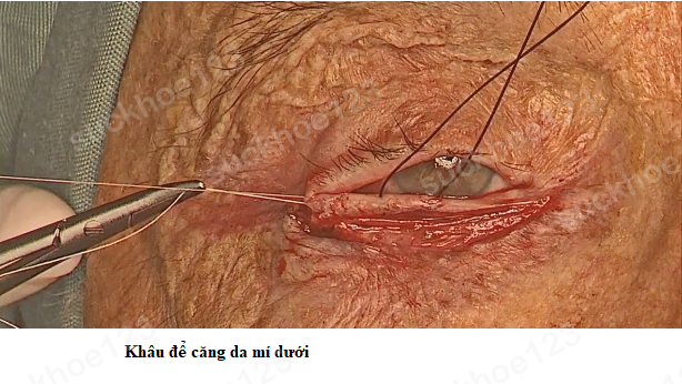 lật mí dưới 5 PT căng da mí dưới 4