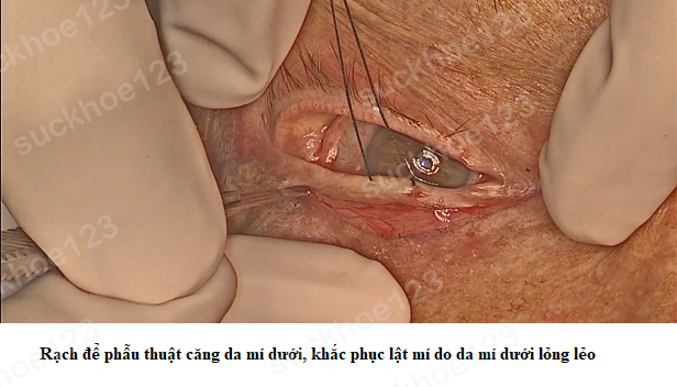 lật mí dưới 5 PT căng da mí dưới