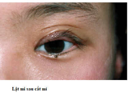 lật mi trên